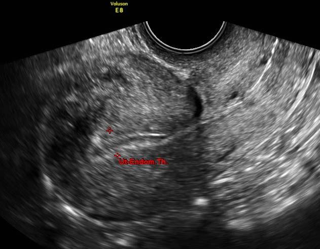 Patient Case #5 A 36 year old P2 presents regarding heavy regular menses Prior tubal sterilization Bimanual examination: bulky, mobile, nontender uterus Transvaginal ultrasonography finds bulky