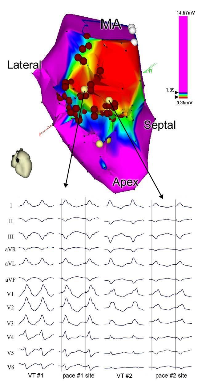 Unmappable VTs Ablation strategies Linear lesions (Marchlinsky, Circulation 2000) Scar Mitral annulus Scar scar Transsection of channels of slow conduction within the