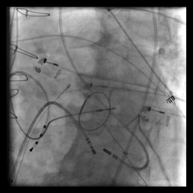 approaches to VT ablation may be