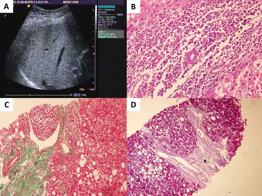 The role of non-invasive methods in evaluating liver fibrosis of patients with nonalcoholic steatohepatitis RESEARCH ARTICLE Figure 2. (A) ARFI: F3 (1.