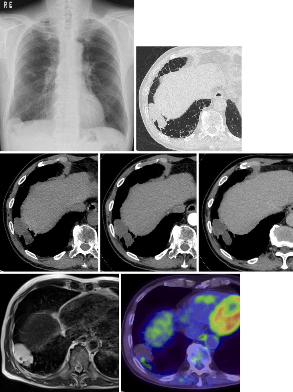 (a) (b) (c) (d) (e) (f) (g) Figure 1. Radiologic findings in a 76-year-old man with primary pulmonary colloid adenocarcinoma. (a) Chest radiograph shows a mass in the right lower lung field.