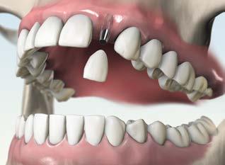 The special elasticity of the plastic abutment protects the implant during the healing phase.