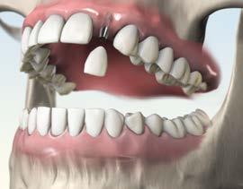 And that s not all: the jawbone under the bridge can degrade due to a lack of functional loading. Do nothing look out for tooth misalignment Doing nothing is cheaper, but is no solution.