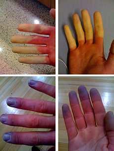 Raynaud Triple-colour changes: White, Blue/Gray, Red sharply demarcated In the hand, only involves fingers, never proximal to the