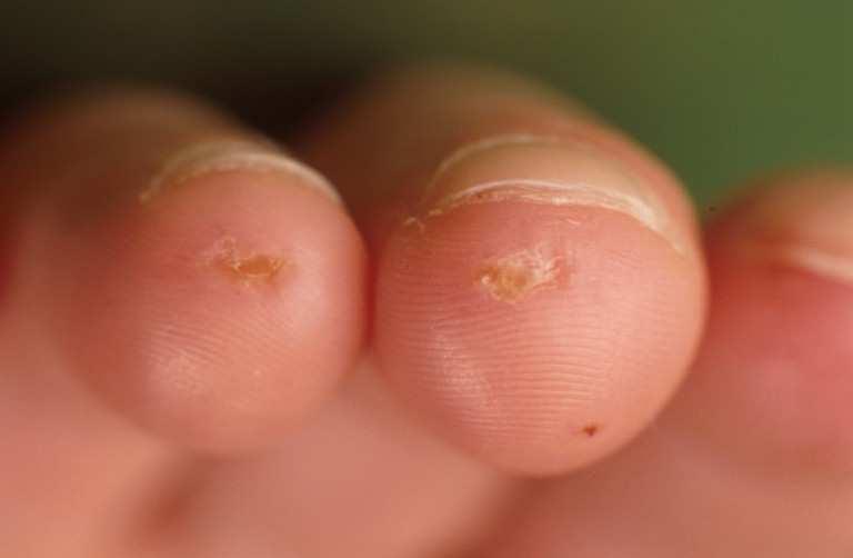 Secondary raynaud Ischaemic lesions are typically located at the