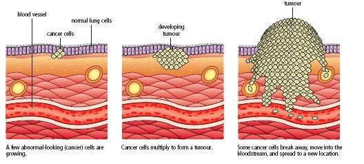 Skin cancer - diagram Cancer how it spreads When viewed with a microscope, cancer cells also show large, abnormal nuclei.