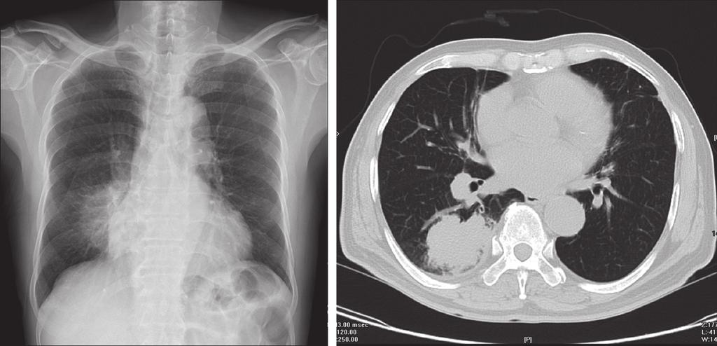 Fig. 1. Plain radiogram and axial CT scan of the chest which shows the huge adenocarcinoma located in right lower lung. A B C Fig. 2.