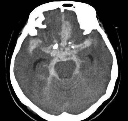 Fig. 1 Axial non-contrast CT image shows high attenuation within the subarachnoid spaces, representative of spontaneous subarachnoid haemorrhage secondary to intracranial aneurysm rupture. Fig.