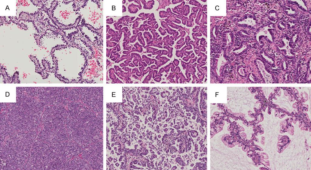 Figure 1. Histogical substypes of lung carcinoma: A. Lepidic substype; B. Papillary substype; C. Acinar substype; D. Solid substype; E. Micropapillary substype; F. Mucinous adenocarcinoma substype.