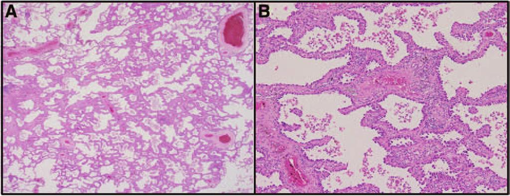 Journal of Thoracic Oncology Volume 8, Number 5, May 2013 New Classification in Stage I Lung Adenocarcinoma neoplasm, with glandular differentiation or mucin production and histopathologic patterns,