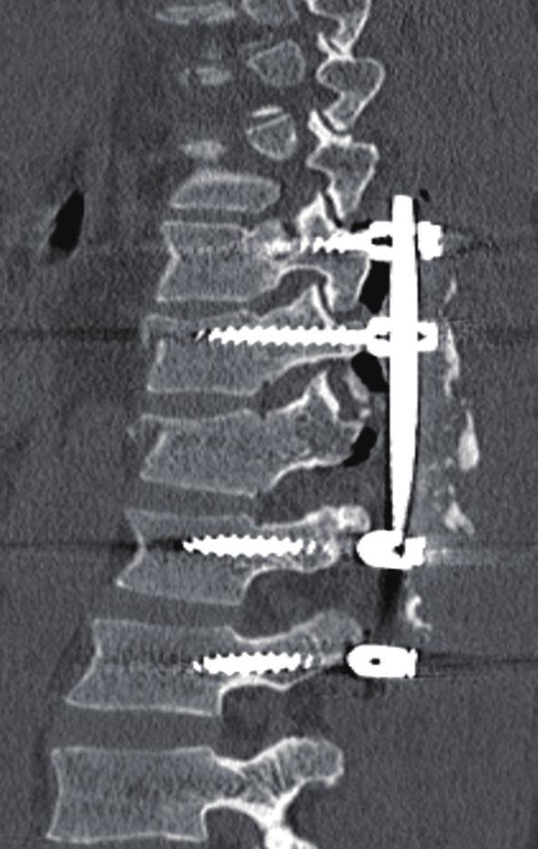 Journal of Spine Surgery, Vol 4, No 2 June 2018 399 Discussion Figure 1 This post-operative CT scan demonstrates the standard operation executed for all the patients.