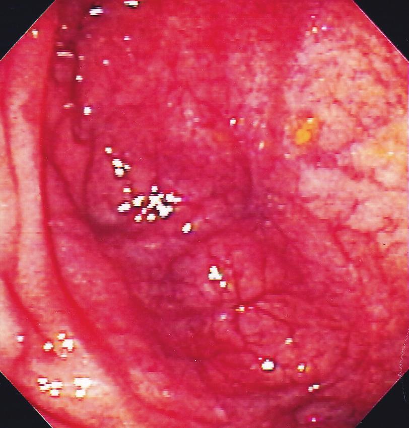 Gastroenterology Research and Practice 3 (a) (b) Figure 2: (a) Normal endoscopic appearance of the ileal pouch after infliximab therapy.