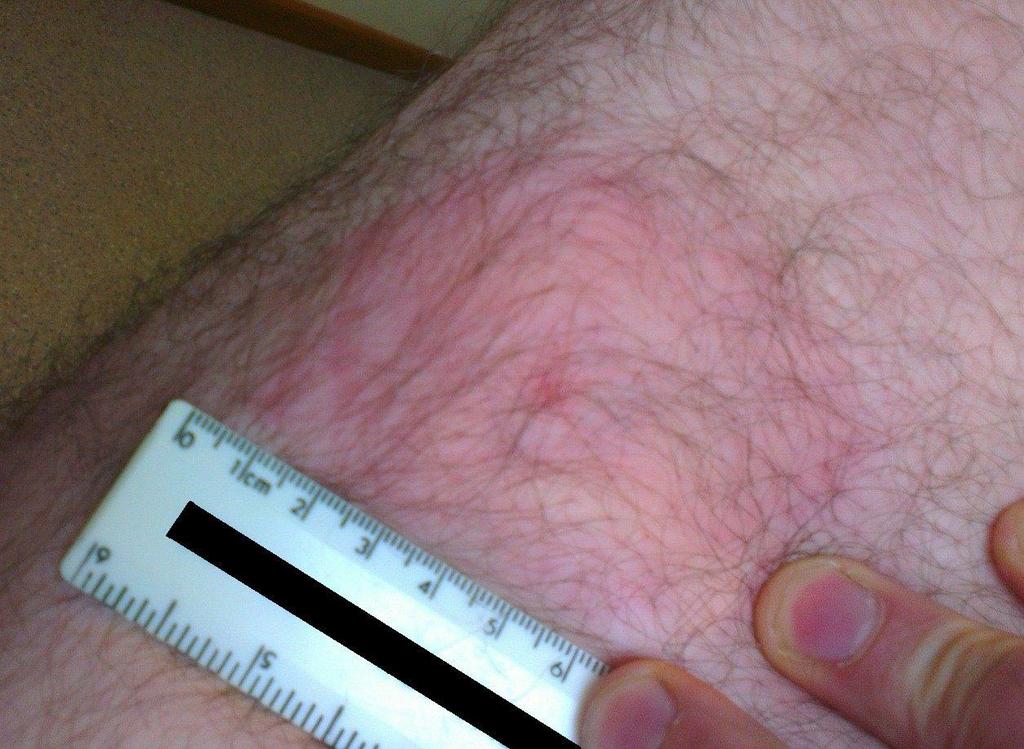 24 hours after tick bite - hypersensitivity reaction 14 day