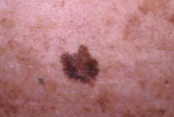 In 2008 the incidence of melanoma in Australia was 11,442 and 1224 people died from melanoma.