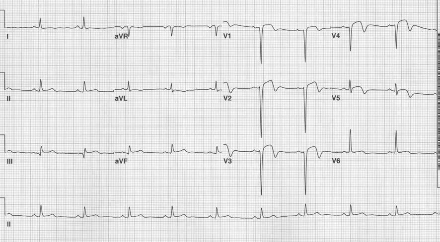 EKG : at