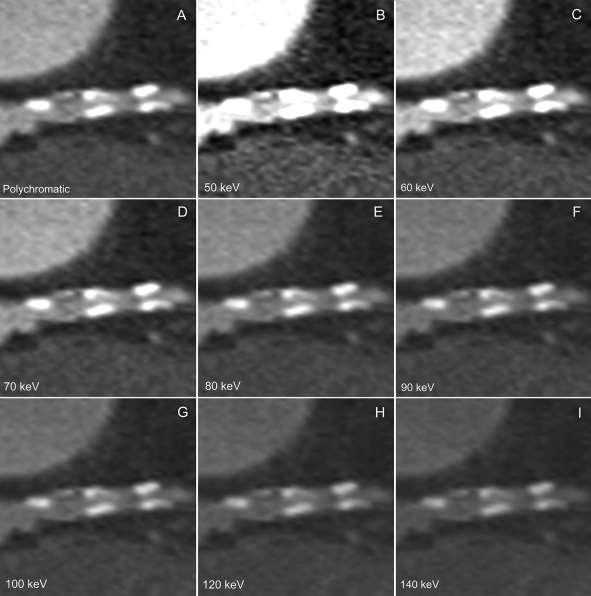 Impact of monochromatic coronary computed tomography angiography from single-source dual-energy CT on