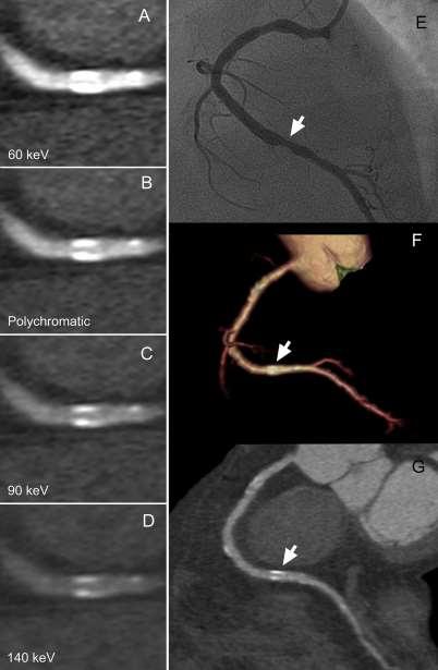 Impact of monochromatic coronary computed tomography angiography from single-source dual-energy CT on