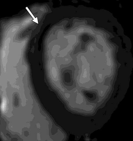 a, Short-axis images of SPECT (A) and MRI (B) examinations at rest show subendocardial
