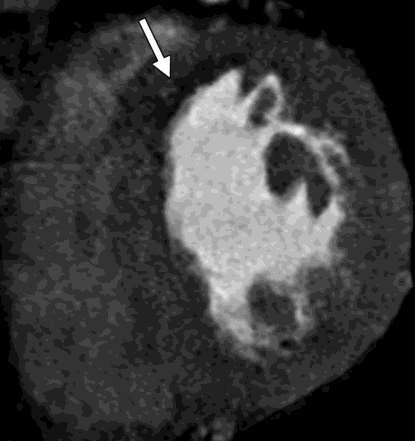 50-year-old man with recurrent chest pain after prior myocardial infarction in left anterior