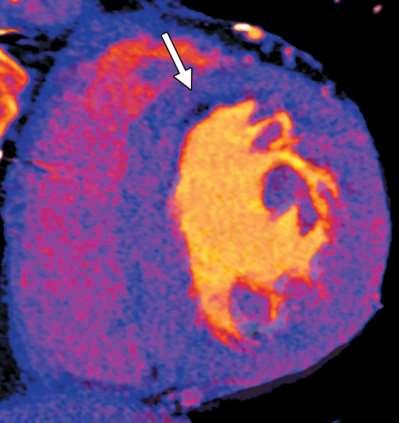 , Corresponding short-axis cross-section of contrastenhanced dual-energy CT study at rest,