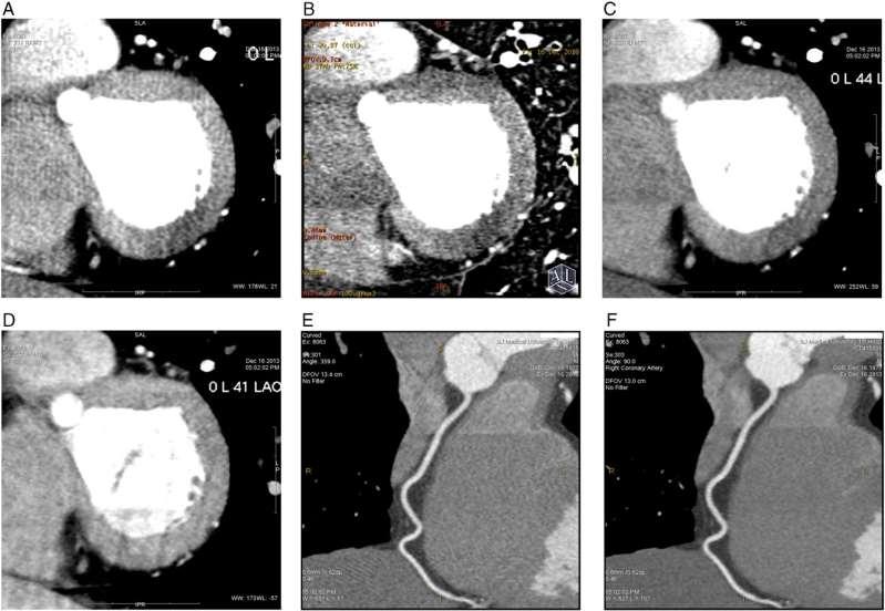 Dual-energy CT might be a better way for optimising myocardial and