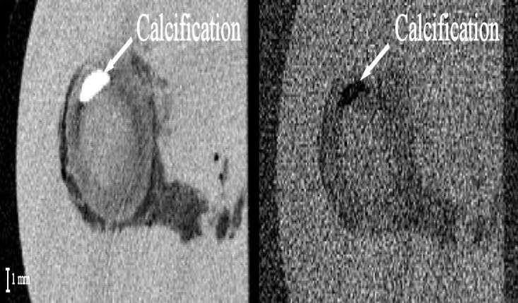 Results Iodine map and calcifications CT-like