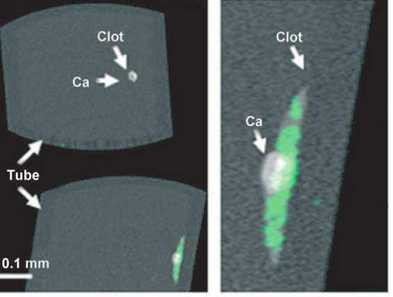 Molecular imaging Fibrin using bismuth loaded nanoparticles D Pan et al Computed Tomography in