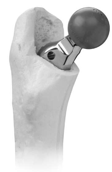 When the appropriate femoral head implant is confirmed, remove the Femoral Head Provisional and check to ensure that the 12/14 taper is clean and dry.