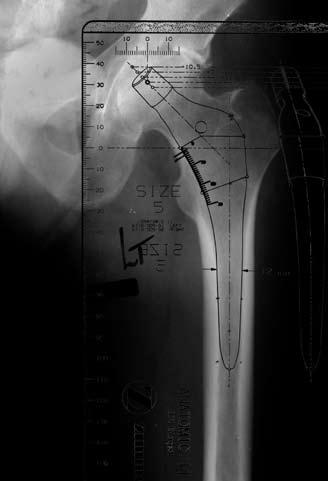 APS Natural-Hip System Surgical Technique Component Size Selection/ Templating Preoperative planning for insertion of a cementless anatomic femoral component requires at least two views of the