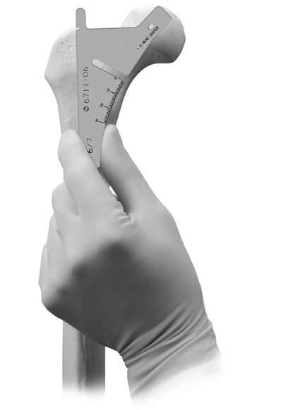 APS Natural-Hip System Surgical Technique Superimpose the Osteotomy Guide (Fig. 2) on the femur. This guide is a metal replica of the acetate template.