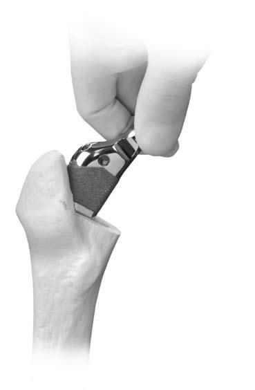 APS Natural-Hip System Surgical Technique Trial Reduction Assemble the appropriately sized Neck Provisional and Provisional Femoral Head to the Rasp and perform a trial reduction (Fig. 8).