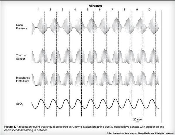 decrescendo change in breathing amplitude with a cycle length of 40 seconds.