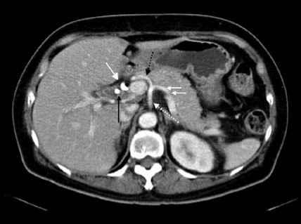 Singapore Med J 2007; 48 (4) : 362 IMAGE INTERPRETATION US showed a calculus within the gallbladder (dotted white arrow), and another echogenic calculus within the common bile duct (CBD) (short white