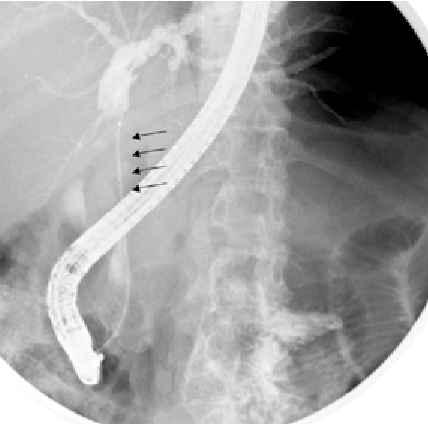 As the compression was extrinsic, a biliary stent was inserted to decompress the proximal biliary system.