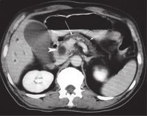 producing the double-duct sign, and (c) a low-density mass (arrow) at the head of pancreas.
