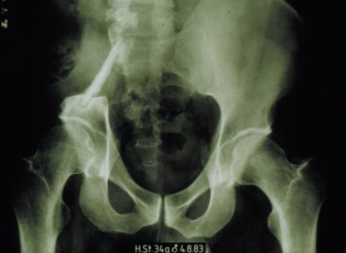 PELVIC SURGERY Iliofemoral arthrodesis Saddle prosthesis (Saddle