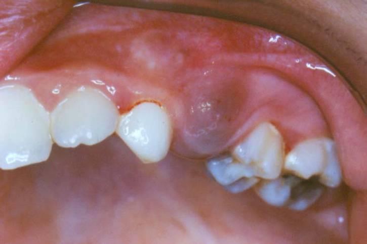 odreďivanje pozicije zubi, stadija razvoja i eventualno postojanje patoloških promjena, kao i utvrďivanje nepostojanja zubnog zametka.