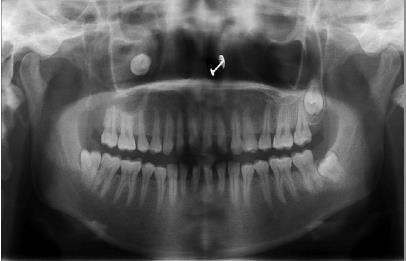 spominju se smanjen rast čeljusti, prerani gubitak mliječnih zubi i prerano nicanje gornjeg prvog trajnog kutnjaka (14).