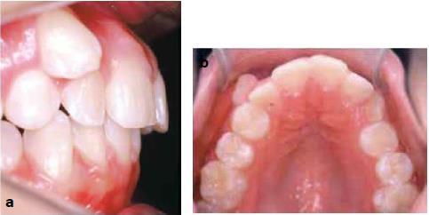 zubnom luku, a najčešče niču palatinalno. Središnji sjekutići ektopično niču zbog prekobrojnog zuba, odontoma ili ranije traume, a niču visoko u forniksu (15). Slika 9.
