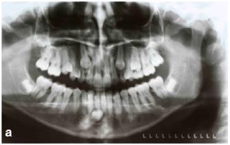 mukozna (zub je u potpunosti retiniran u mukozi). Takvi zubi mogu izazvati resorpciju korijena susjednog zuba (17).