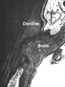 U slučaju traume ili upale dolazi do prestanka aktivnosti fibroblasta, pa je omogućeno stvaranje nove kosti (20). Slika 11. Fuzija dentina i kosti. Uočava se nepostojanje parodontnog ligamenta.