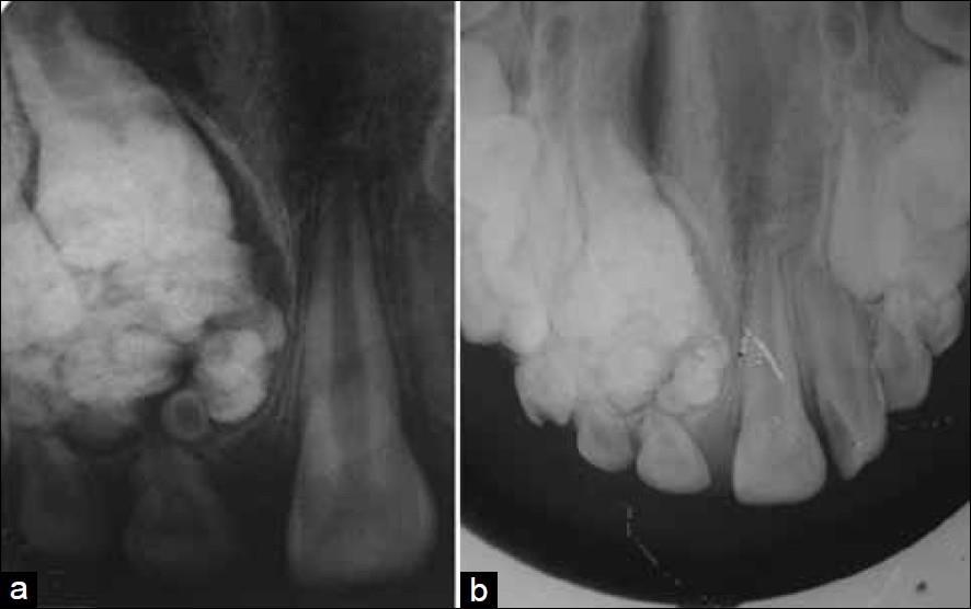 Slika 16. a) periapikalna snimka prikazuje radioopaknu strukturu povezanu sa zubima 51 i 52.