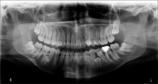 11.0. PREKOBROJNI ZUBI Stanje koje je karakterizirano većim brojem zubi nego u normalnoj denticiji nazivamo prekobrojnim zubima ili hiperdoncijom.