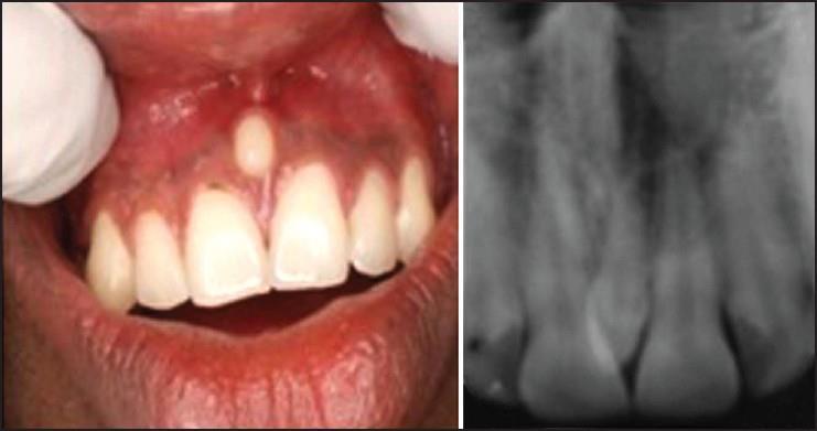 Dvije su glavne podjele prekobrojnih zuba: prema obliku i lokaciji. Podjela prema obliku (32): 1. Suplementarni: zub ima normalan oblik i veličinu. 2.