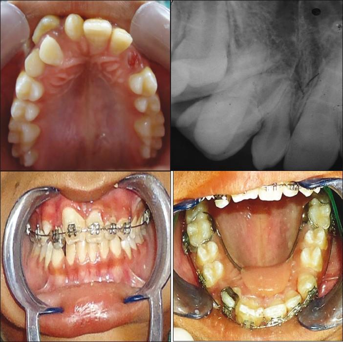 Liječenje prekobrojnih zubi ovisi o njihovom broju i lokalizaciji.