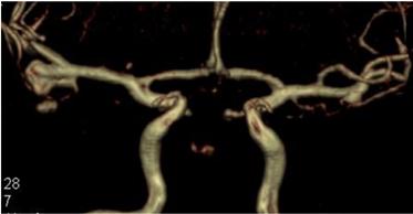 evaluate the possibility of an endovascular