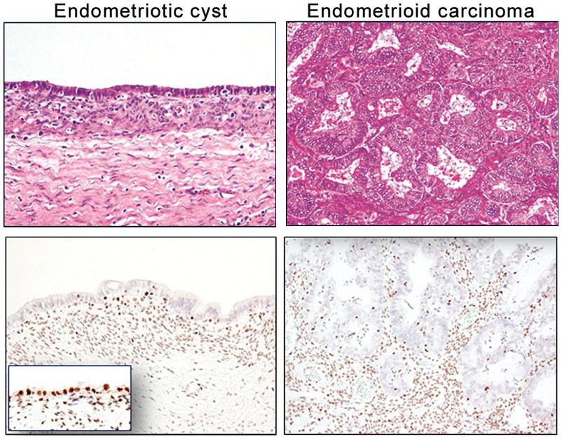 Ayhan et al. Page 8 Fig. 1. ARID1A immunoreactivity in a representative case (No. 32) containing an endometriotic cyst and associated well-differentiated endometrioid carcinoma.