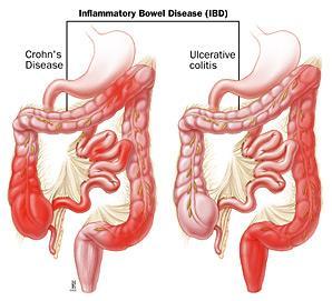 Slika 1. Razlika u zahvaćenosti crijeva kod Crohnove bolesti i ulceroznog kolitisa. Preuzeto: (26) 4. ORALNE MANIFESTACIJE UPALNIH BOLESTI CRIJEVA 4.1. Oralne manifestacije Crohnove bolesti Oralne manifestacije Crohnove bolesti javljaju se u 0.