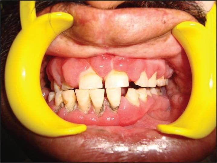 4.1.3. Hiperplastični gingivitis Hiperplastični gingivitis karakterizira edematozna, granulirana i hiperplastična gingiva do mukogingivalne granice (18).