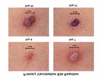 IMPORTANT VACCINATION INFORMATION This is how your vaccination site will progress: Major (primary) reaction Expected vaccine site reaction and progression following primary smallpox vaccination or